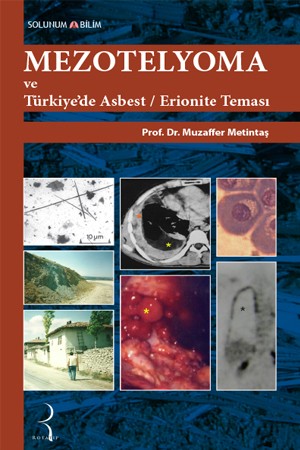 Mezotelyoma ve Türkiye'de Asbest/Erionite Teması